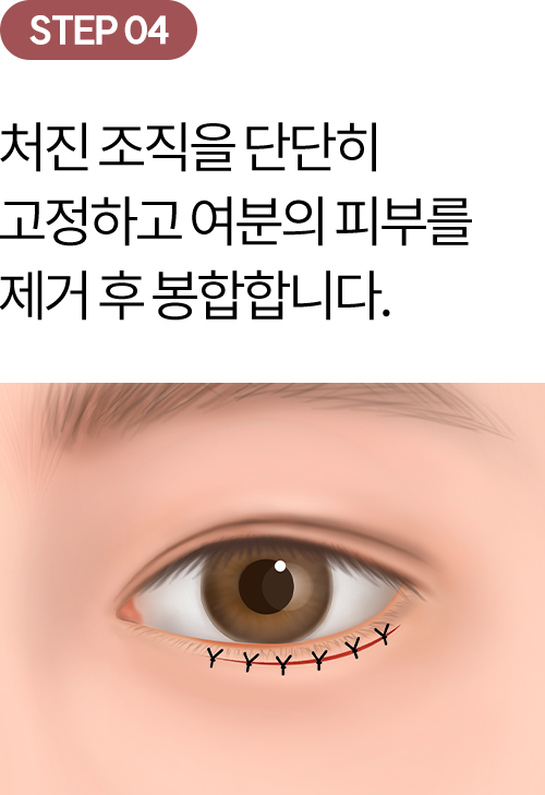 eye_modul_ha_04 eye_modul_ha_04